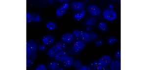 Hybridation in situ en fluorescence avec une sonde ERBB2/CEP17